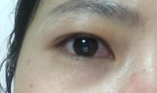 眼睛去近视手术 眼睛去近视手术